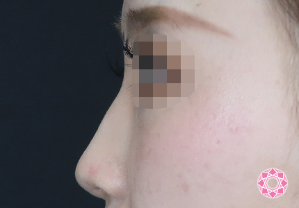 年代：20代 施術名：ジュビダーム 施術前｜【公式】東京形成美容外科