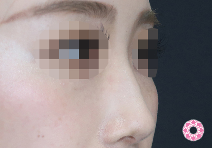 年代：20代 施術名：ジュビダーム 施術前｜【公式】東京形成美容外科