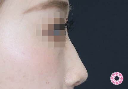 年代：20代 施術名：ジュビダーム 施術前｜【公式】東京形成美容外科