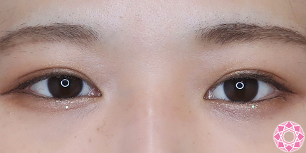 年代：20代 施術名：二重埋没法 施術後｜【公式】東京形成美容外科