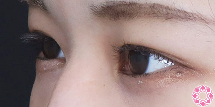 年代：20代 施術名：二重埋没法 施術後｜【公式】東京形成美容外科