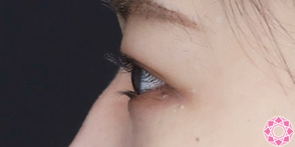 年代：20代 施術名：二重埋没法 施術後｜【公式】東京形成美容外科