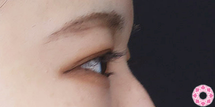 年代：20代 施術名：二重埋没法 施術後｜【公式】東京形成美容外科