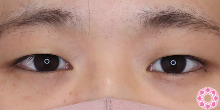 年代：20代 施術名：二重埋没法 施術前｜【公式】東京形成美容外科