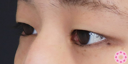 年代：20代 施術名：二重埋没法 施術前｜【公式】東京形成美容外科