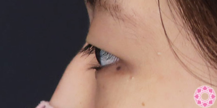 年代：20代 施術名：二重埋没法 施術前｜【公式】東京形成美容外科