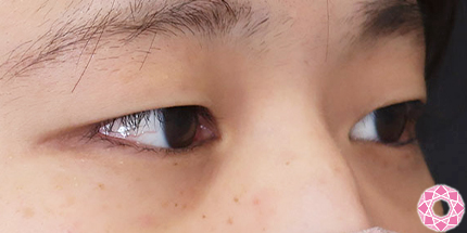 年代：20代 施術名：二重埋没法 施術前｜【公式】東京形成美容外科