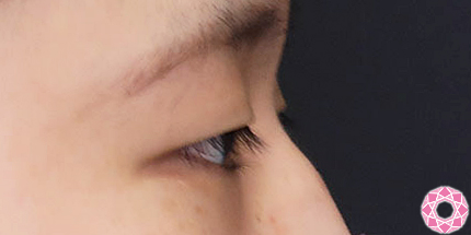 年代：20代 施術名：二重埋没法 施術前｜【公式】東京形成美容外科