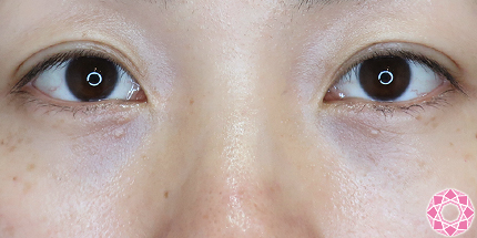 年代：30代 施術名：目の下のふくらみ取り 施術後｜【公式】東京形成美容外科