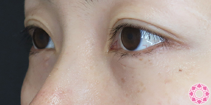 年代：30代 施術名：目の下のふくらみ取り 施術後｜【公式】東京形成美容外科