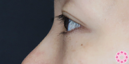 年代：30代 施術名：目の下のふくらみ取り 施術後｜【公式】東京形成美容外科