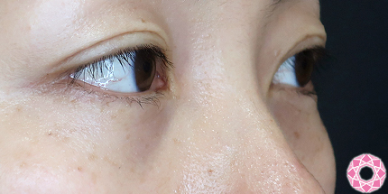 年代：30代 施術名：目の下のふくらみ取り 施術後｜【公式】東京形成美容外科