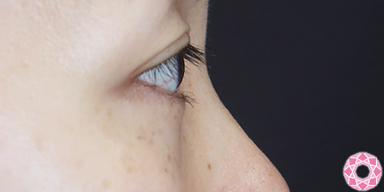 年代：30代 施術名：目の下のふくらみ取り 施術後｜【公式】東京形成美容外科