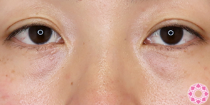 年代：30代 施術名：目の下のふくらみ取り 施術前｜【公式】東京形成美容外科