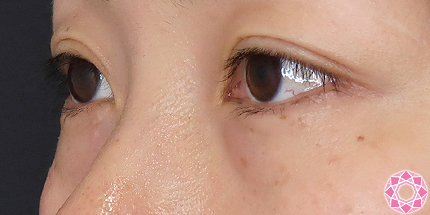 年代：30代 施術名：目の下のふくらみ取り 施術前｜【公式】東京形成美容外科