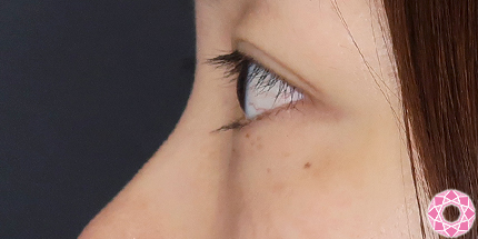 年代：30代 施術名：目の下のふくらみ取り 施術前｜【公式】東京形成美容外科