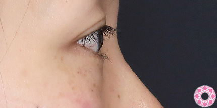 年代：30代 施術名：目の下のふくらみ取り 施術前｜【公式】東京形成美容外科