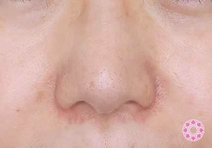 年代：50代 施術名：小鼻縮小 施術後｜【公式】東京形成美容外科