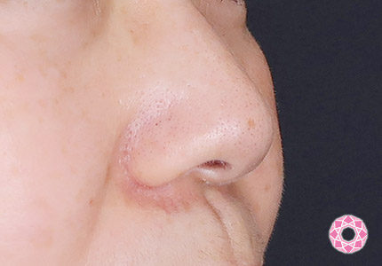 年代：50代 施術名：小鼻縮小 施術後｜【公式】東京形成美容外科