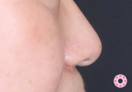 年代：50代 施術名：小鼻縮小 施術後｜【公式】東京形成美容外科