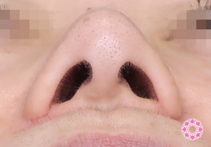 年代：50代 施術名：小鼻縮小 施術後｜【公式】東京形成美容外科