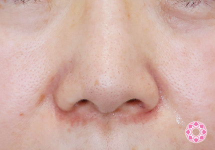 年代：50代 施術名：小鼻縮小 施術前｜【公式】東京形成美容外科