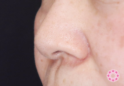 年代：50代 施術名：小鼻縮小 施術前｜【公式】東京形成美容外科