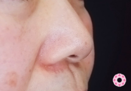 年代：50代 施術名：小鼻縮小 施術前｜【公式】東京形成美容外科