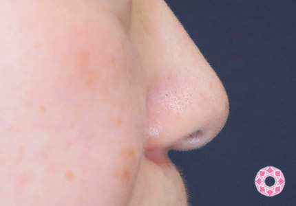 年代：50代 施術名：小鼻縮小 施術前｜【公式】東京形成美容外科