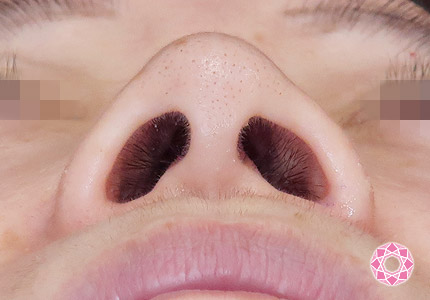 年代：50代 施術名：小鼻縮小 施術前｜【公式】東京形成美容外科