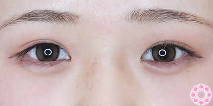 年代：20代 施術名：ジュビダーム 施術後｜【公式】東京形成美容外科