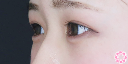 年代：20代 施術名：ジュビダーム 施術後｜【公式】東京形成美容外科