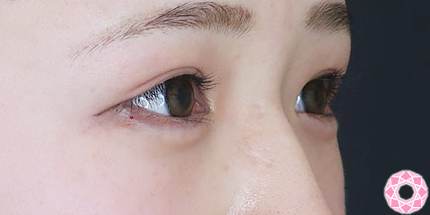 年代：20代 施術名：ジュビダーム 施術後｜【公式】東京形成美容外科