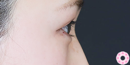 年代：20代 施術名：ジュビダーム 施術後｜【公式】東京形成美容外科