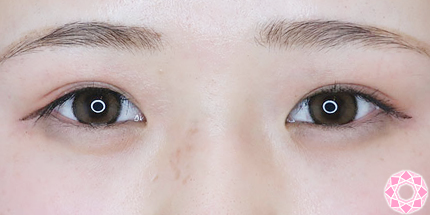 年代：20代 施術名：ジュビダーム 施術前｜【公式】東京形成美容外科