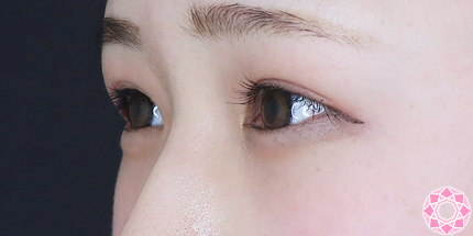 年代：20代 施術名：ジュビダーム 施術前｜【公式】東京形成美容外科