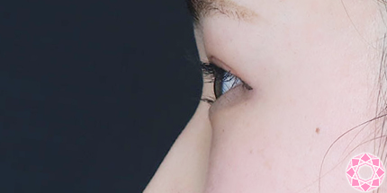 年代：20代 施術名：ジュビダーム 施術前｜【公式】東京形成美容外科