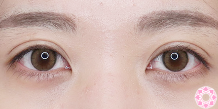 年代：20代 施術名：二重埋没法 施術後｜【公式】東京形成美容外科