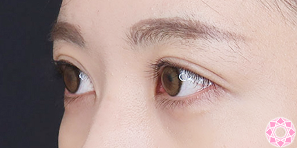 年代：20代 施術名：二重埋没法 施術後｜【公式】東京形成美容外科