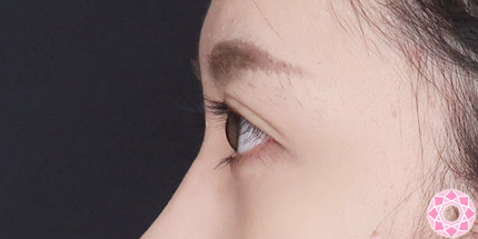 年代：20代 施術名：二重埋没法 施術後｜【公式】東京形成美容外科