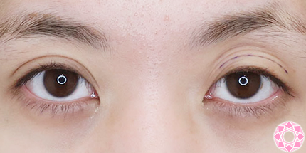 年代：20代 施術名：二重埋没法 施術前｜【公式】東京形成美容外科