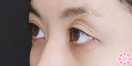 年代：20代 施術名：二重埋没法 施術前｜【公式】東京形成美容外科