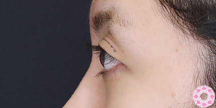 年代：20代 施術名：二重埋没法 施術前｜【公式】東京形成美容外科