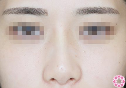 年代：20代 施術名：プチ隆鼻術（ヒアルロン酸） 施術後｜【公式】東京形成美容外科