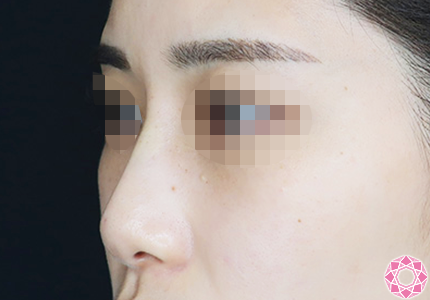 年代：20代 施術名：プチ隆鼻術（ヒアルロン酸） 施術後｜【公式】東京形成美容外科