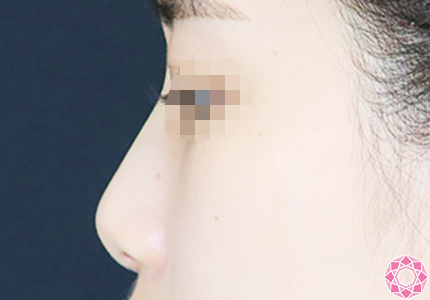 年代：20代 施術名：プチ隆鼻術（ヒアルロン酸） 施術後｜【公式】東京形成美容外科