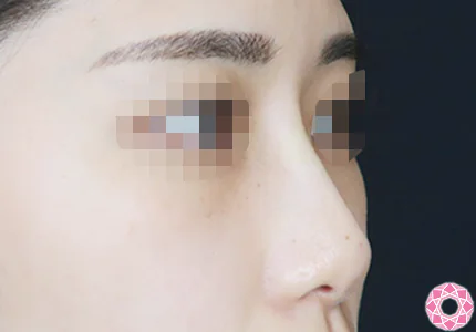 年代：20代 施術名：プチ隆鼻術（ヒアルロン酸） 施術後｜【公式】東京形成美容外科