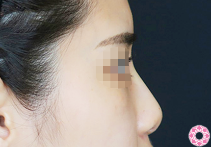 年代：20代 施術名：プチ隆鼻術（ヒアルロン酸） 施術後｜【公式】東京形成美容外科