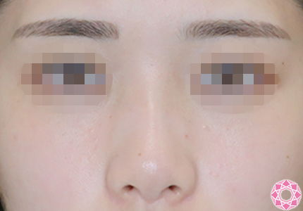 年代：20代 施術名：プチ隆鼻術（ヒアルロン酸） 施術前｜【公式】東京形成美容外科