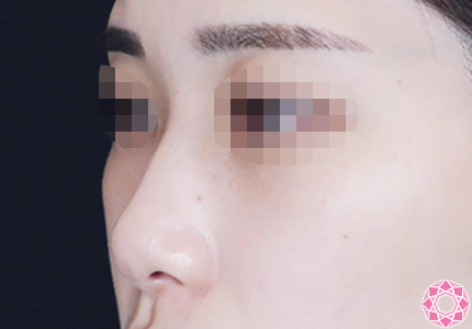 年代：20代 施術名：プチ隆鼻術（ヒアルロン酸） 施術前｜【公式】東京形成美容外科